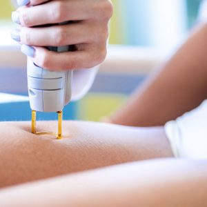 Laser Hair Removal