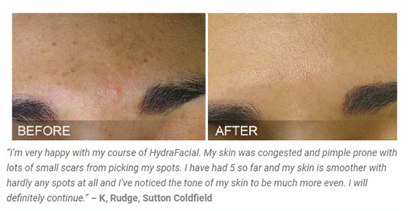 hydrafacial-results-1-1