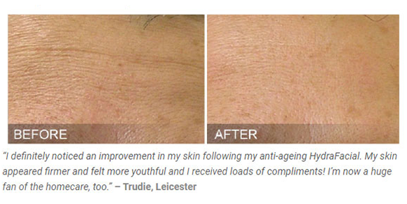 hydrafacial-results-2