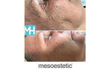 mesoeclat-@mouritshuiditherapie