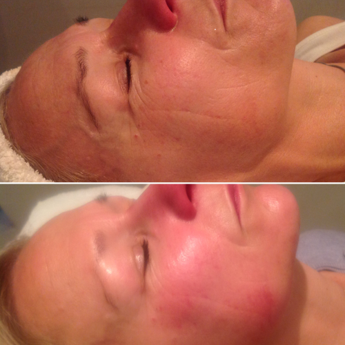 Skin Rejuvenation Before and Immediatley After_ Dermalux and Skin Peel