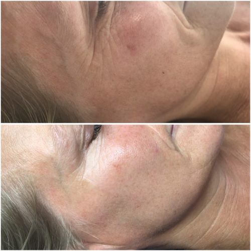 Tri-Wave Rejuvenation