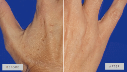 Results in a single session of mesopeel TCA 35%.