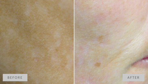 Focal application of mesopeel melanoplus. Reduction of hyperpigmentation.