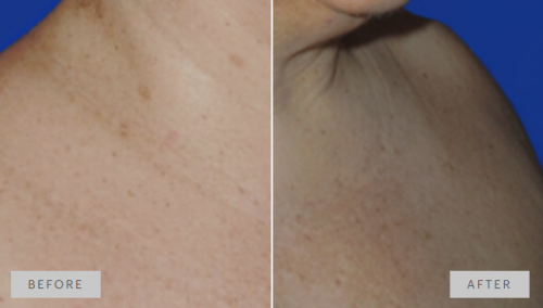 Focal application of mesopeel melanoplus on the neckline. Reduction of hyperpigmentation.
