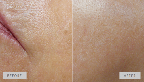 Results in a single session of mesopeel phenTCA. Renewed and more radiant skin.
